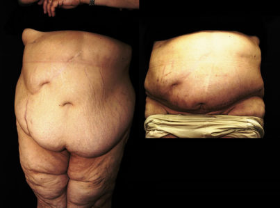 Body Contouring After Major Weight Loss Surgery