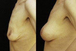 Body Contouring After Major Weight Loss
