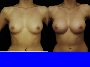 Breast Augmentation Gainesville