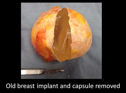 Correction of Implant Problems Performed by Another Surgeon Surgery