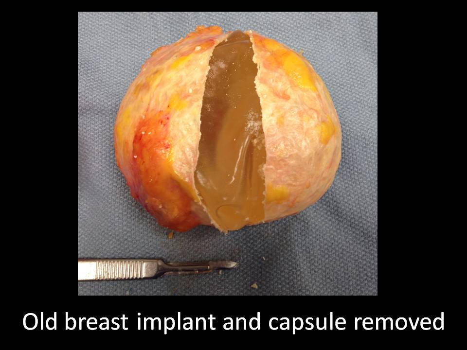 Correction of Implant Problems Performed by Another Surgeon Surgery