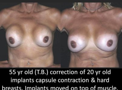 Correction of Implant Problems Performed by Another Surgeon Surgery