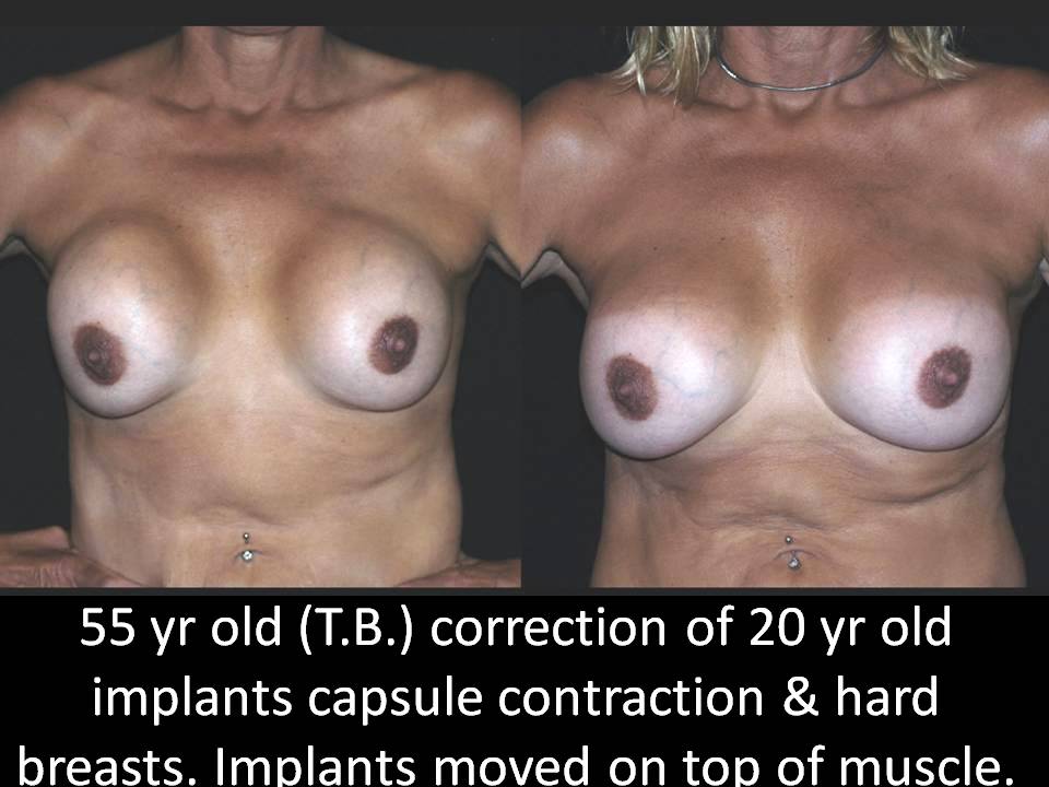 Correction of Implant Problems Performed by Another Surgeon Surgery