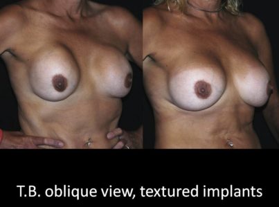 Correction of Implant Problems Performed by Another Surgeon Surgery