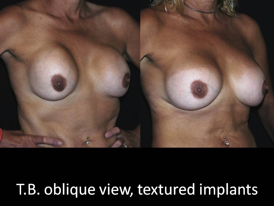 Correction of Implant Problems Performed by Another Surgeon Surgery