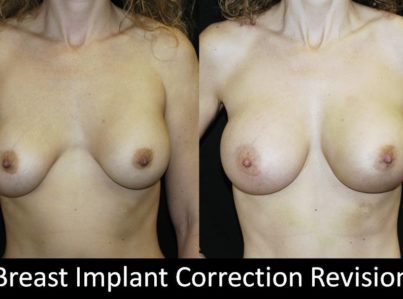Correction of Implant Problems Performed by Another Surgeon Surgery