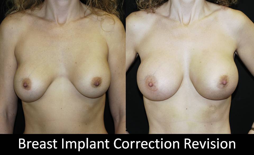 Correction of Implant Problems Performed by Another Surgeon Surgery