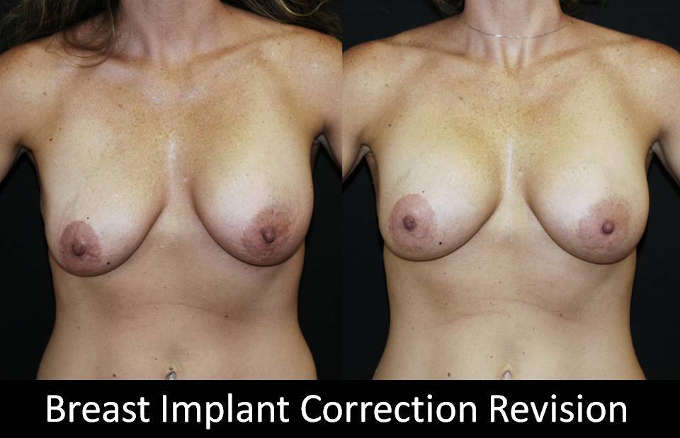 Correction of Implant Problems Performed by Another Surgeon Surgery