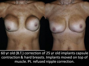 Correction of Implant Problems Performed by Another Surgeon Surgery