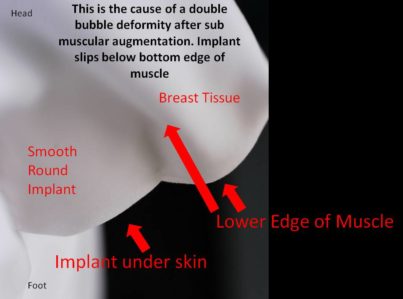 Correction of Implant Problems Performed by Another Surgeon Surgery