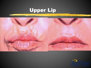 Lip Enhancement/ Wrinkles