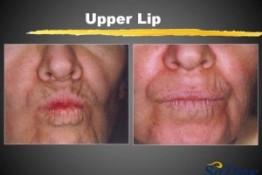 Lip Enhancement/ Wrinkles