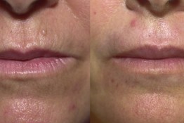 Lip Enhancement/ Wrinkles