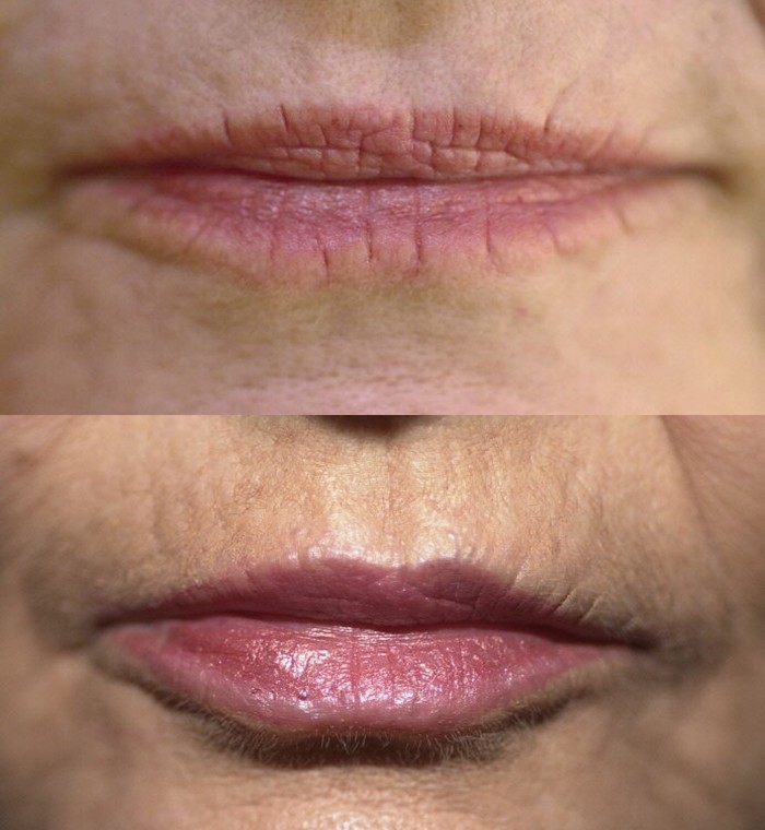 Lip Enhancement/ Wrinkles