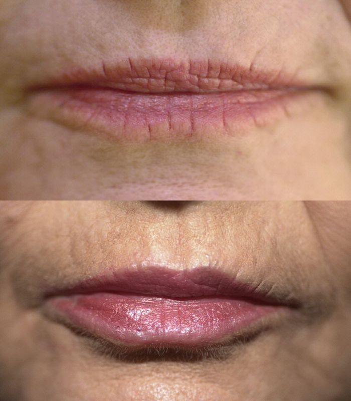 Lip Enhancement/ Wrinkles