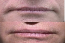 Lip Enhancement/ Wrinkles