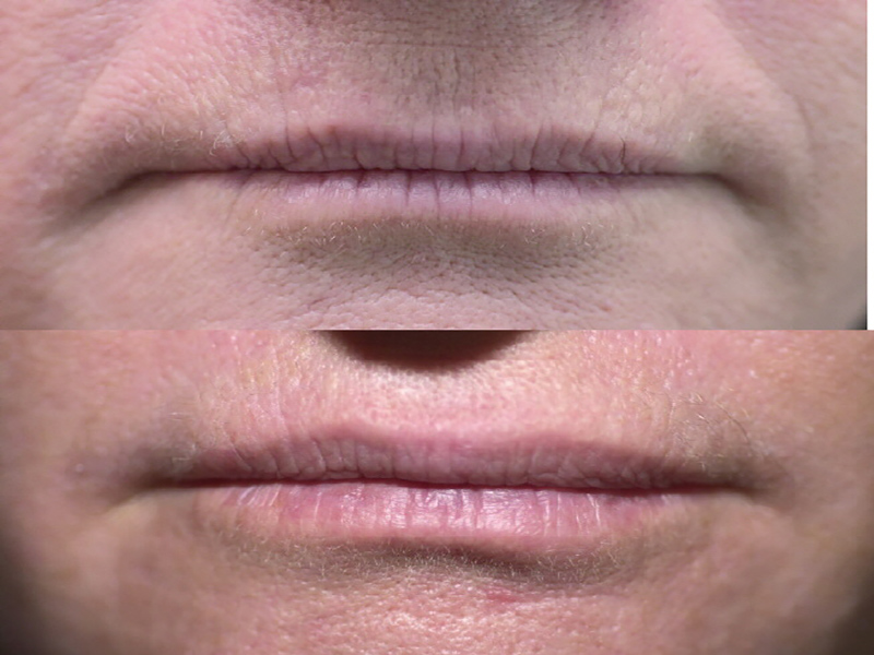 Lip Enhancement/ Wrinkles