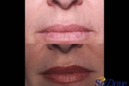 Lip Enhancement/ Wrinkles