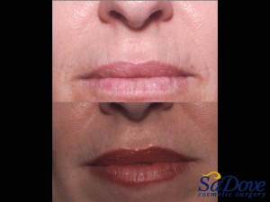 Lip Enhancement/ Wrinkles