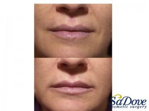 Lip Enhancement/ Wrinkles