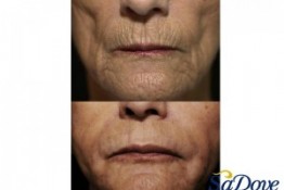 Lip Enhancement/ Wrinkles