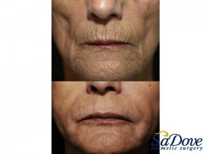 Lip Enhancement/ Wrinkles
