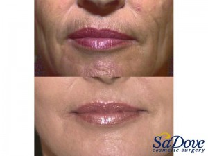 Lip Enhancement/ Wrinkles