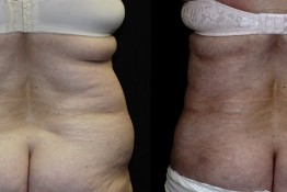 Liposuction Muffin Top