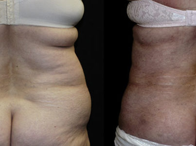 Liposuction Muffin Top