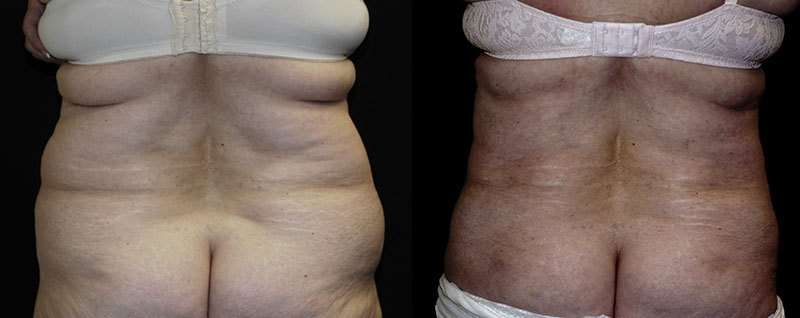 Liposuction Muffin Top