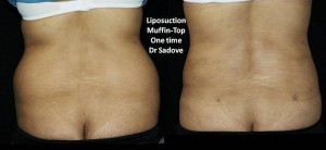Liposuction Muffin Top