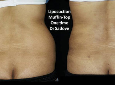 Liposuction Muffin Top