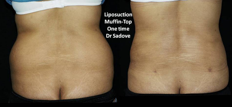 Liposuction of the Muffin Top Waistline Deformity - Explore Plastic Surgery