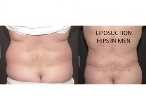 Liposuction Muffin Top