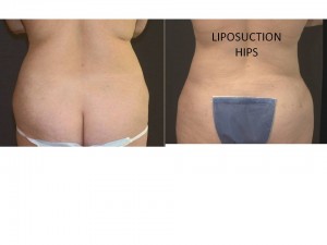 Liposuction Muffin Top