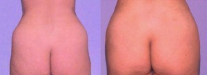 Liposuction Muffin Top