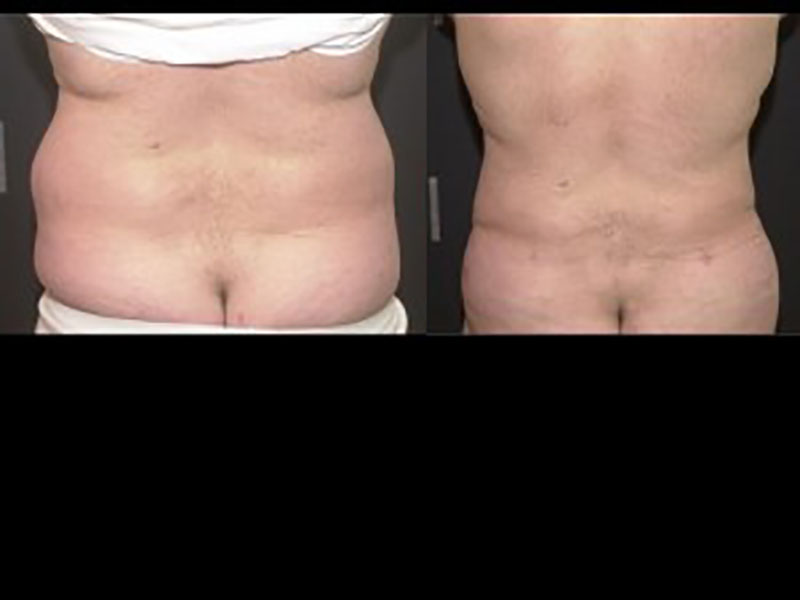 Liposuction Muffin Top