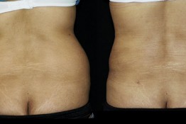 Liposuction Muffin Top