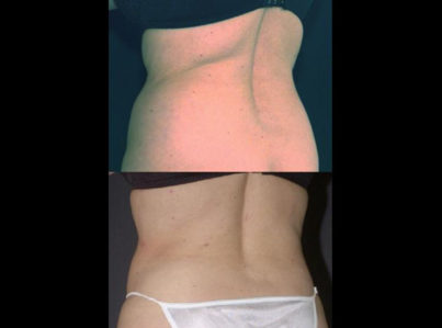 Liposuction Muffin Top Hips20