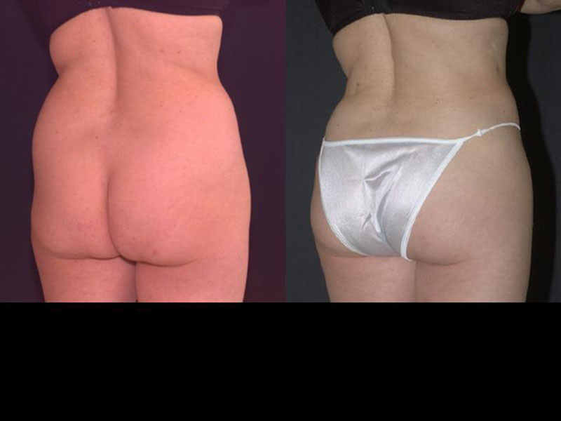 Liposuction Muffin Top