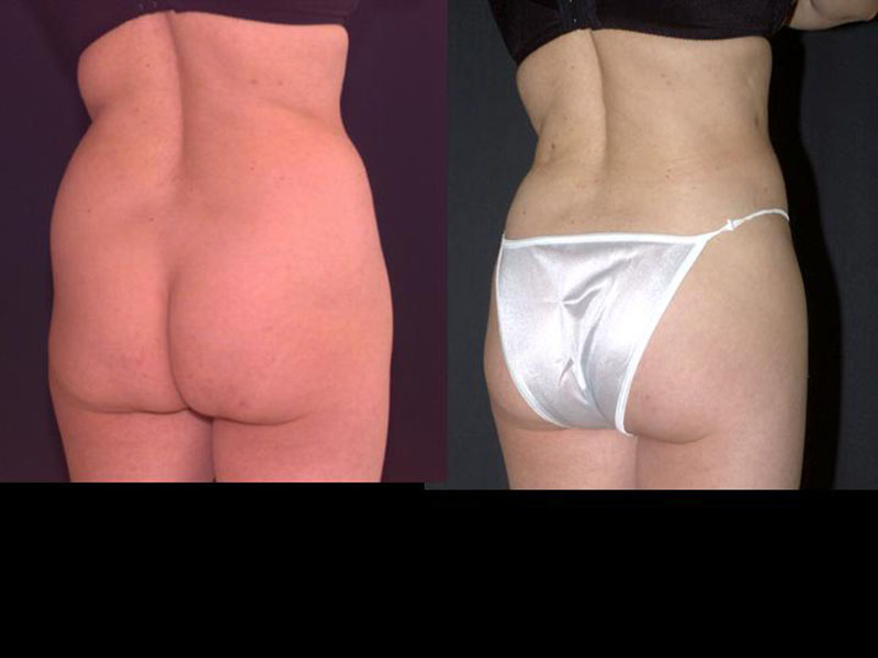 Liposuction Muffin Top