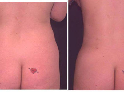 Liposuction Muffin Top