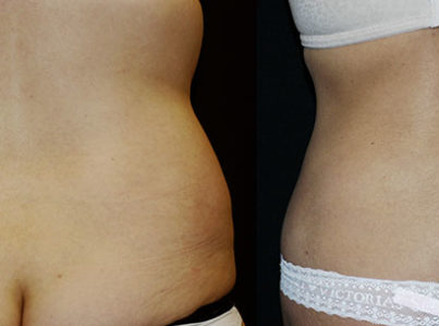 Liposuction Muffin Top Hips