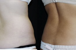 Liposuction Muffin Top