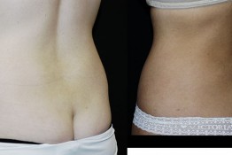 Liposuction Muffin Top