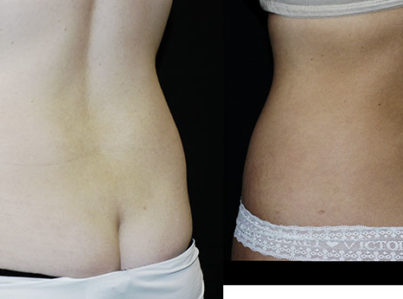 Liposuction Muffin Top