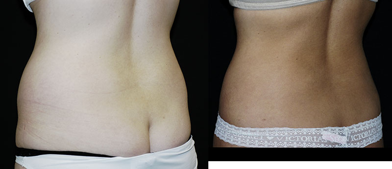 Liposuction Muffin Top