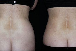 Liposuction Muffin Top