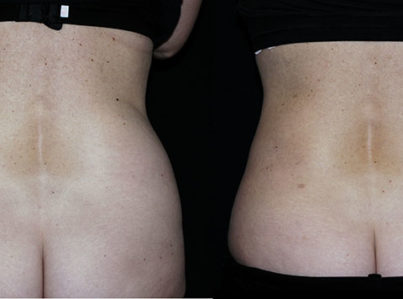 Liposuction Muffin Top