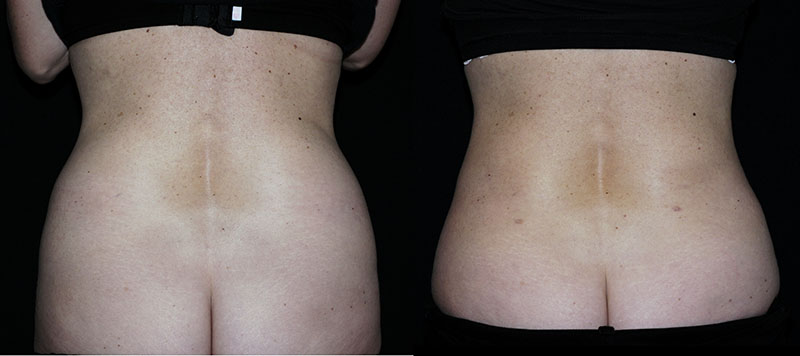 Liposuction Muffin Top